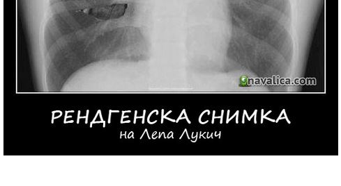Рендгенска снимка на Лепа Лукич – Навалица